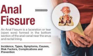 Homeopathy Treatment For Anorectal fissure