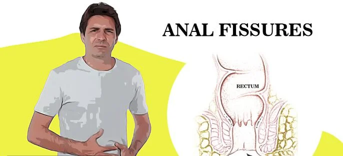 Homeopathy Treatment For Anorectal Fissure