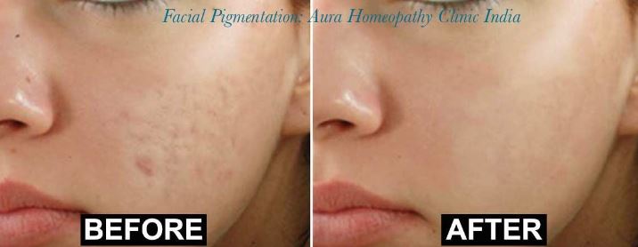 Top Homeopathic Medicines for Facial Pigmentation