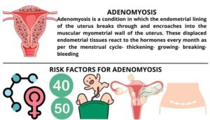 Homeopathy Treatment For Adenomyosis