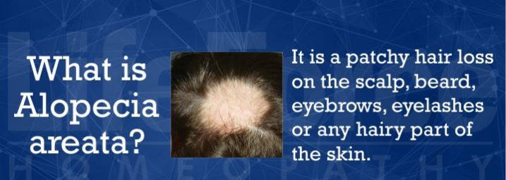 Homeopathy Treatment For Alopecia Areata