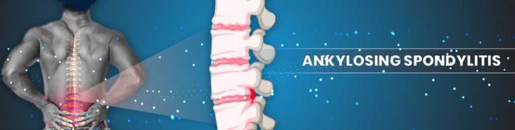 Homeopathy Treatment For Ankylosing Spondylitis India