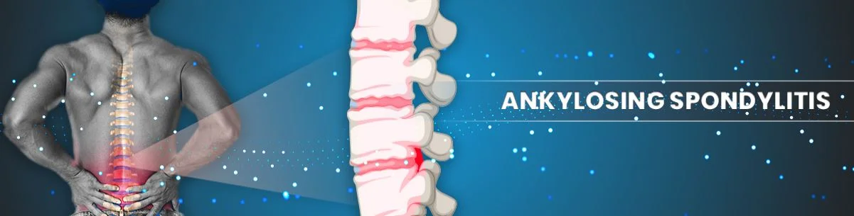 Homeopathy Treatment For Ankylosing Spondylitis India