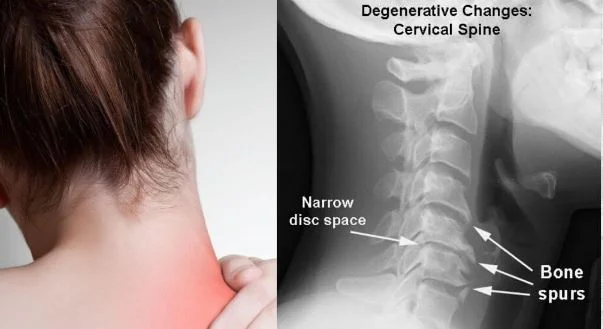 Homeopathy Treatment For Cervical Spondylosis