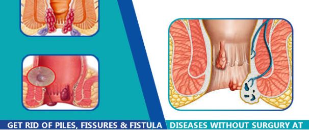 HomeopathyTreatment For Fistula