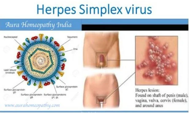 Homeopathy Treatment For Genital Herpes