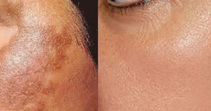 Homeopathy treatment For Skin Pigmentation