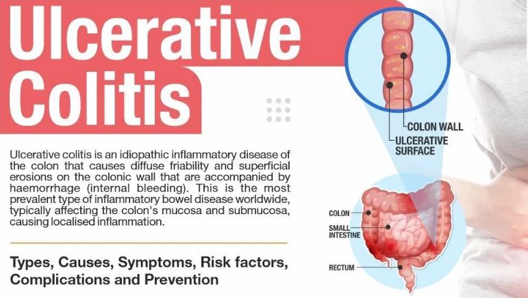 Homeopathy treatment for ulcerative colitis