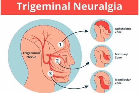 Homeopathy Treatment for Trigeminal Neuralgia