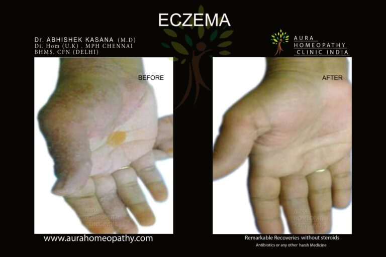 Homeopathy Treatment At