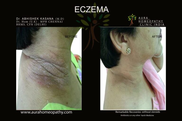 Homeopathy Treatment For Atopic Dermatitis Or Eczema