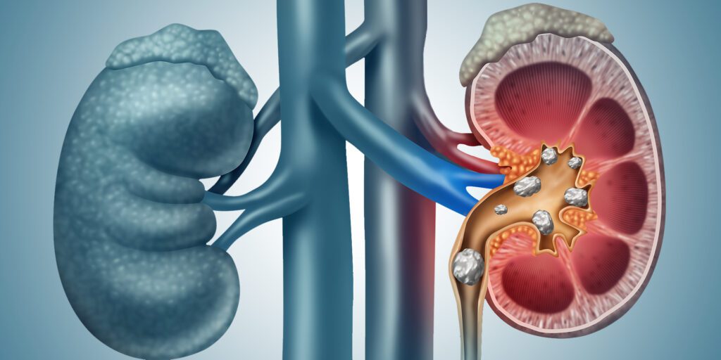 Homeopathy for Chronic Kidney Disease