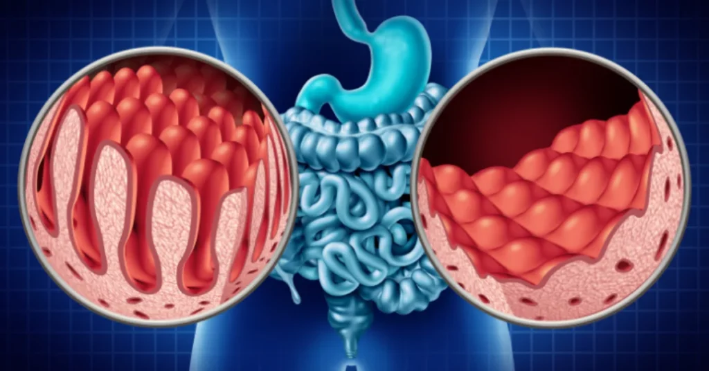 Homeopathy Treatment For Celiac Disease