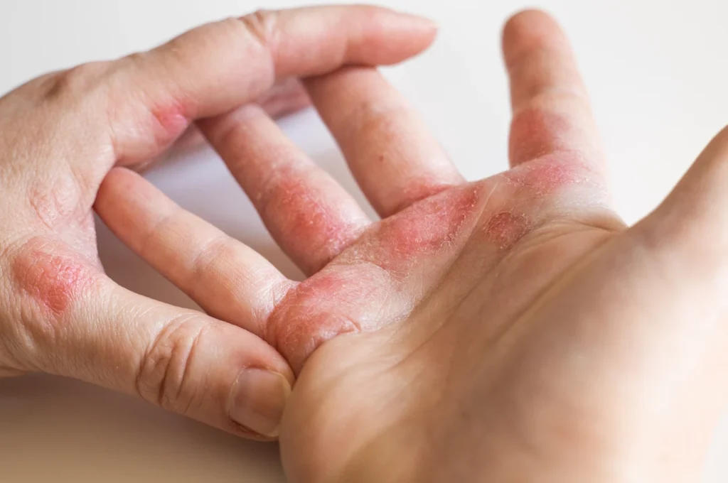 Homeopathy Treatment For Atopic Dermatitis Or Eczema