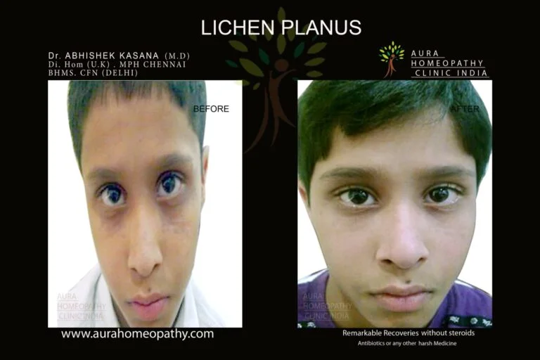 Homeopathy clinic for Lichen Planus