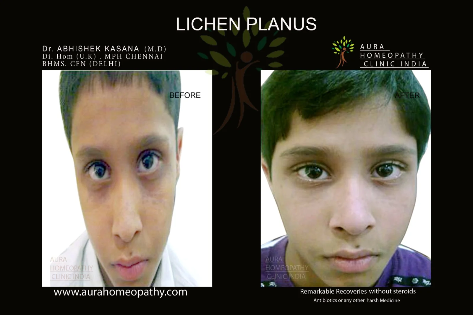 Homeopathy clinic for Lichen Planus