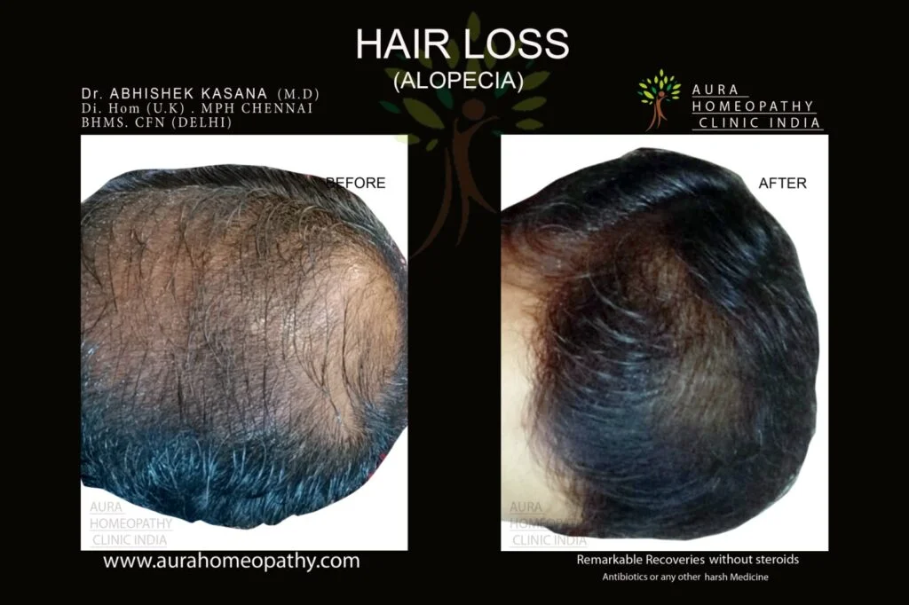 Homeopathy clinic for Hair Loss