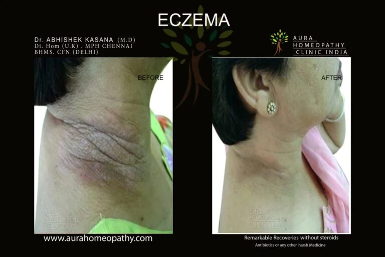 Homeopathy clinic for Eczema