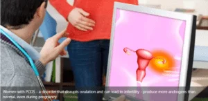 Homeopathy Treatment for PCOS