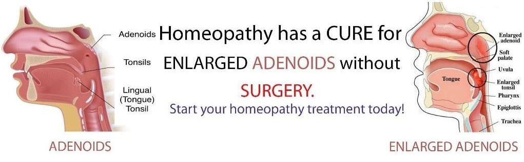 Adenoids Homeopathy treatment