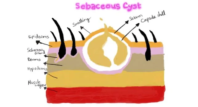 Homeopathy For Sebaceous Cysts