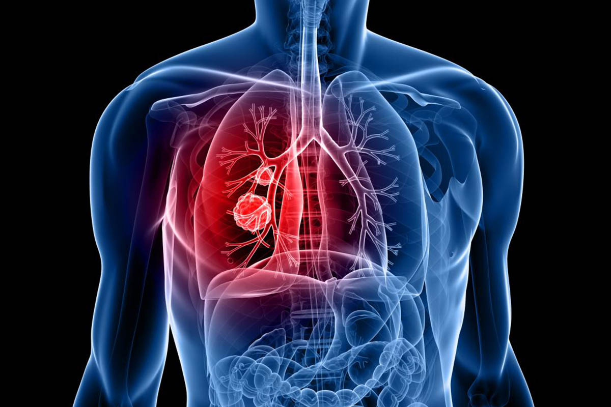 ILD Treatment in Homeopathy