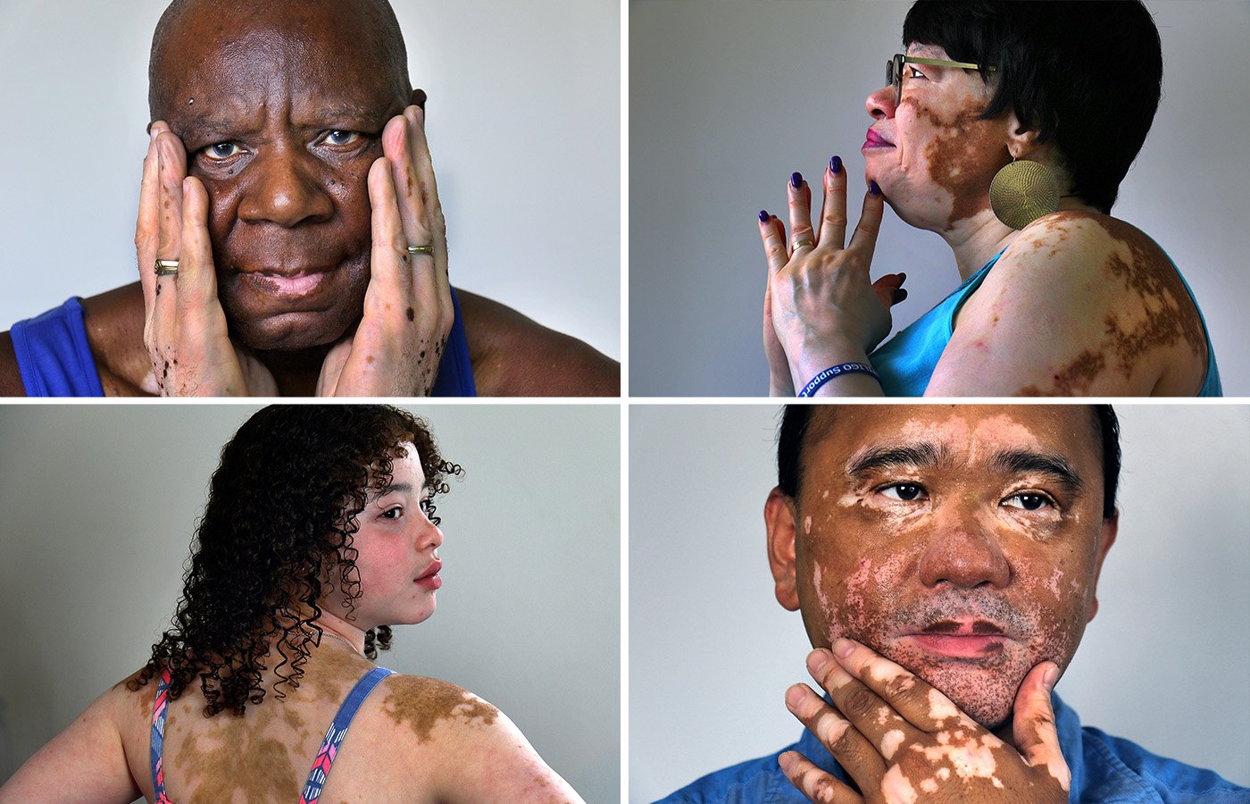 Skin Conditions