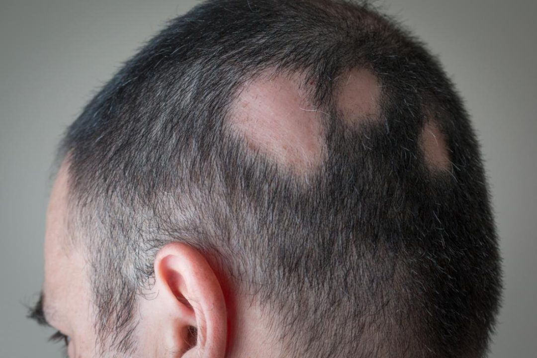 partial-alopecia